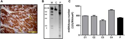 Identification and Characterization of New RNASEH1 Mutations Associated With PEO Syndrome and Multiple Mitochondrial DNA Deletions